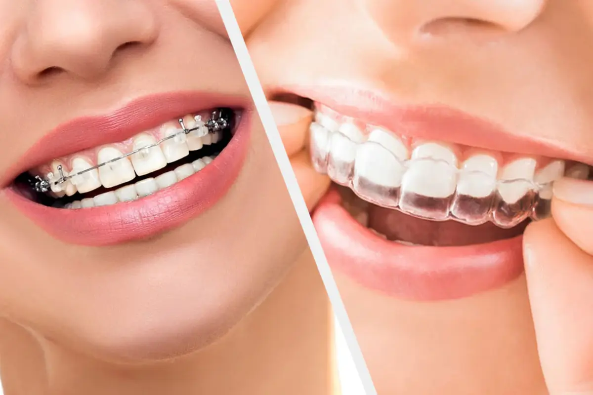 retainers vs dental braces